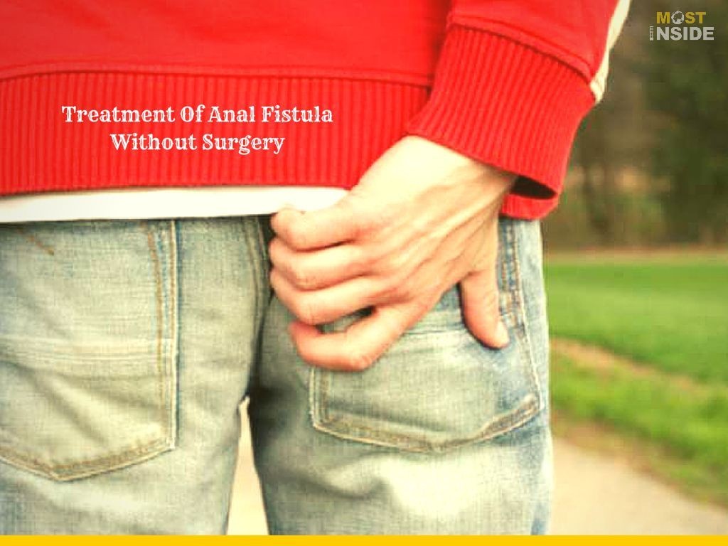 Treatment of anal fistula without surgery