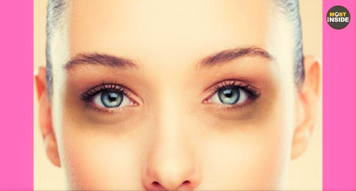 Reasons for Dark Circles