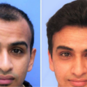 Opt for Cost Effective Hair Transplant in Delhi