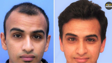 Opt for Cost Effective Hair Transplant in Delhi