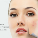 Natural Home Remedies For Treating Skin Pigmentation