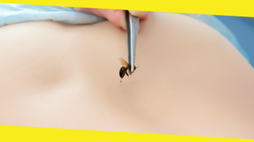 Prevention And Home Remedies For Bee Stings