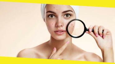 Amazing Tips for Pimple Cure – Quick Read