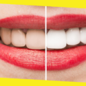 Dummies Guide to Teeth Whitening Products in Australia