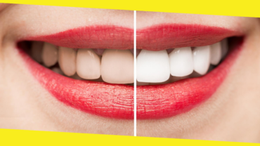 Dummies Guide to Teeth Whitening Products in Australia