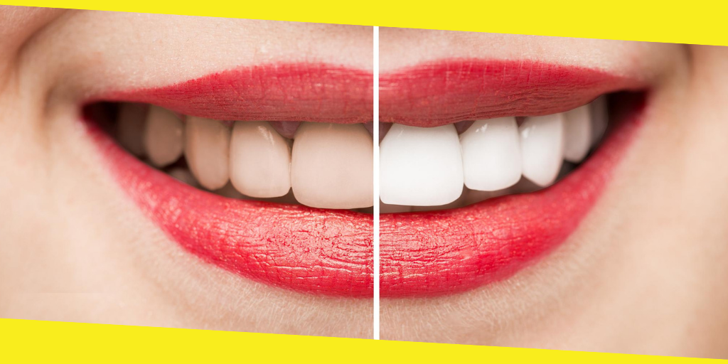 teeth whitening products in Australia