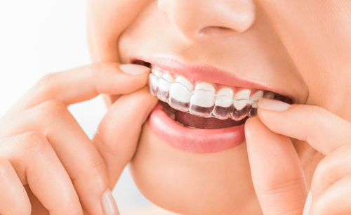 Tips in Maintaining Oral Hygiene When You Have Braces
