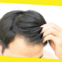 How to Reverse Hair Loss From Burns?