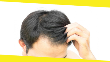 How to Reverse Hair Loss From Burns?