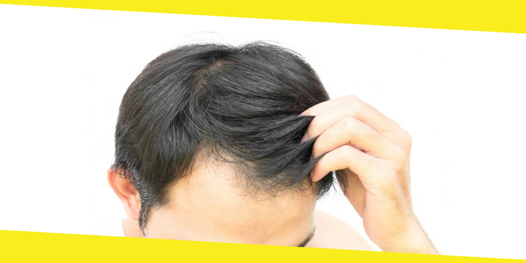 How to Reverse Hair Loss 
