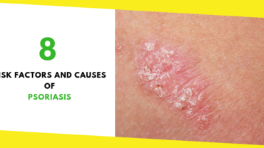 8 Risk Factors and Causes of Psoriasis