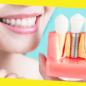 How Much Do Dental Implants Cost?