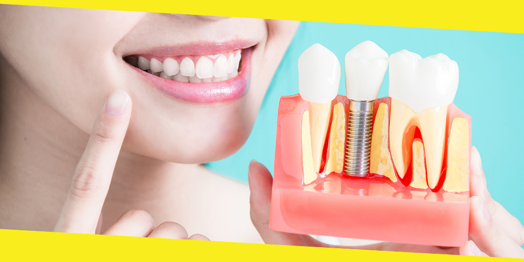 Dental Implants Cost