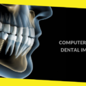 4 Things You Should Know About Computer Guided Dental Implants