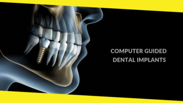 4 Things You Should Know About Computer Guided Dental Implants