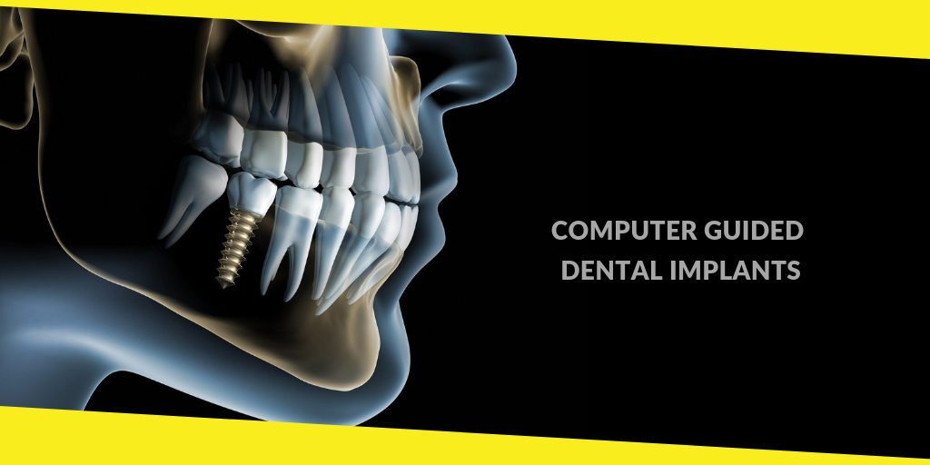 About Computer Guided Dental Implants