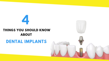 4 Things You Should Know About Dental Implants