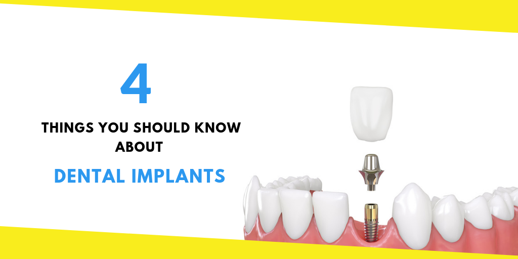 Knowing About Dental Implants