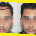 After Hair Transplant Care In Hair Restoration Surgery