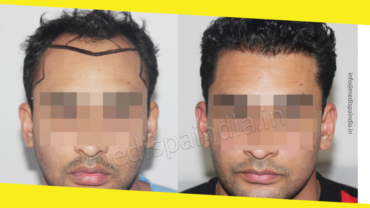 After Hair Transplant Care In Hair Restoration Surgery
