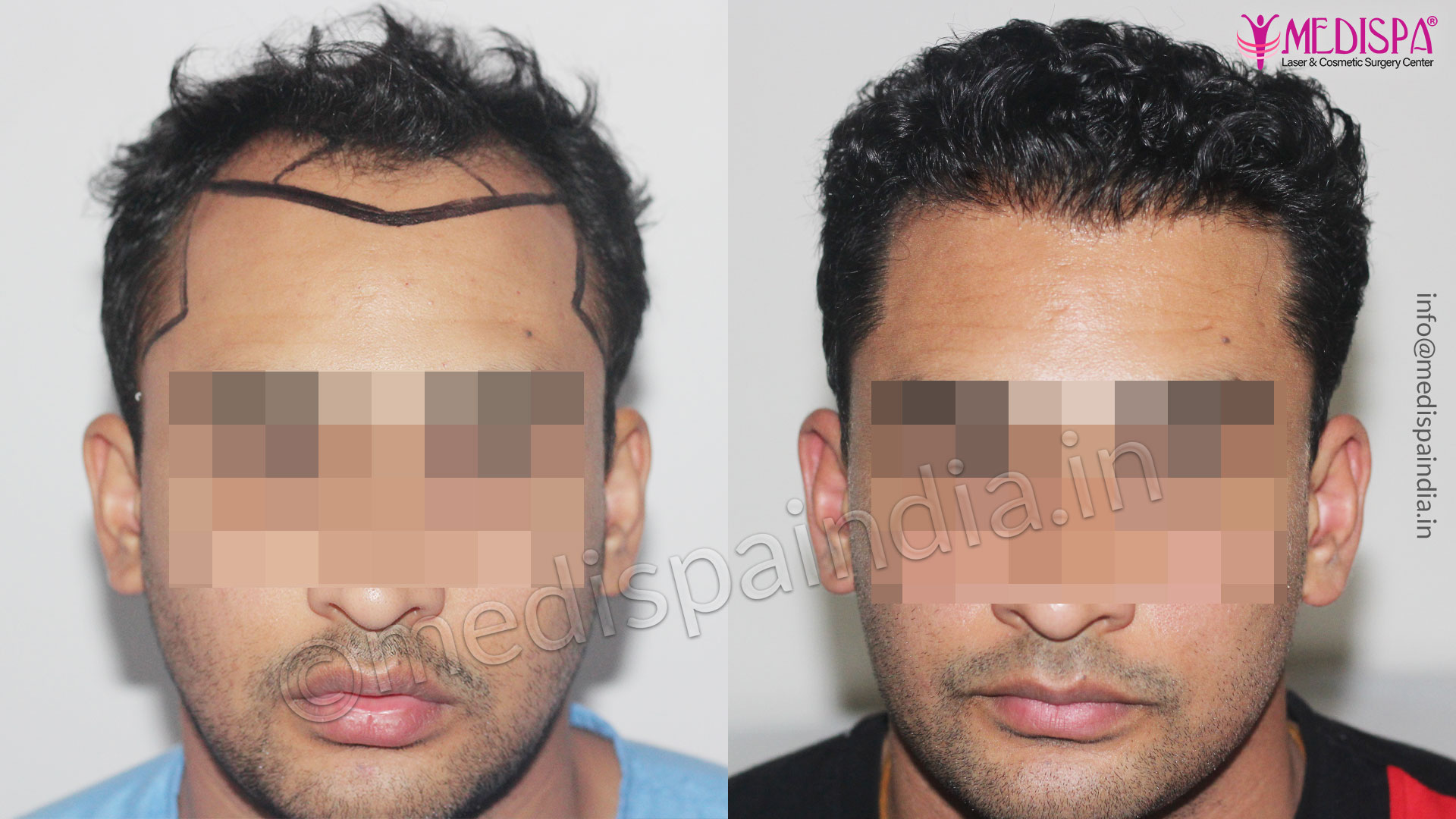 Hair Restoration Surgery