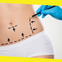 5 Myths And Facts About Tummy Tuck Surgery 
