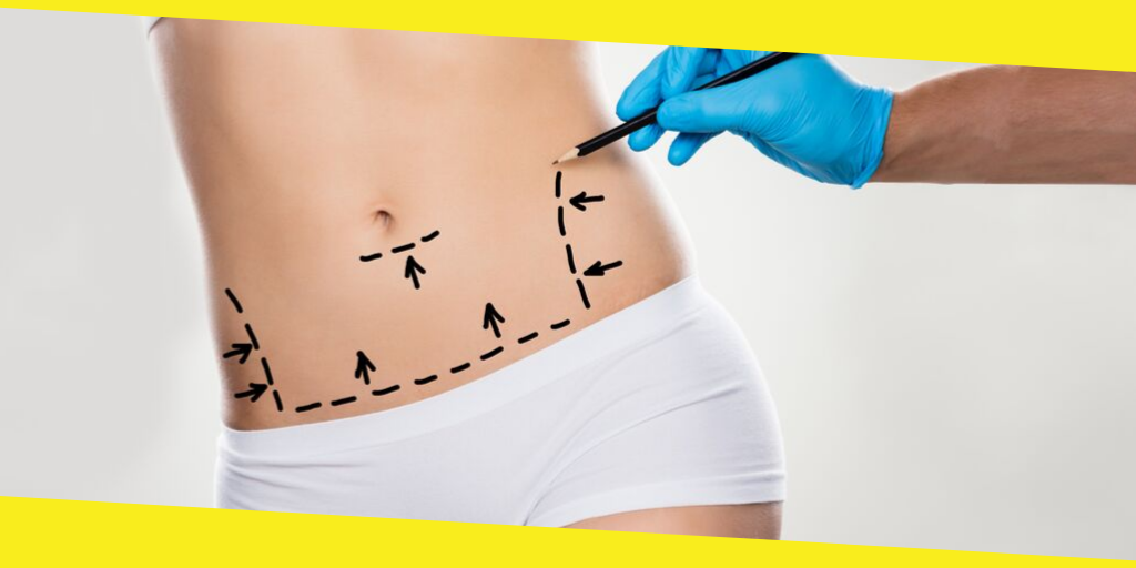 Facts About Tummy Tuck Surgery 