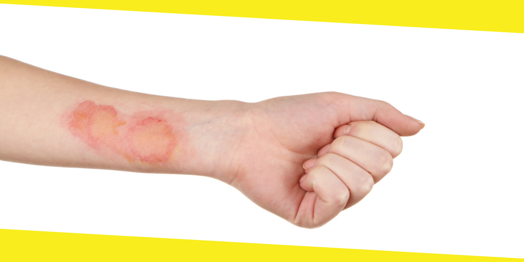 The Difference Between Burns and Scalds Burns vs Scalds