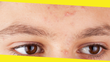 How to Get Rid of Acne for Good