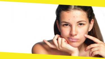 7 Must-Know Facts About Acne