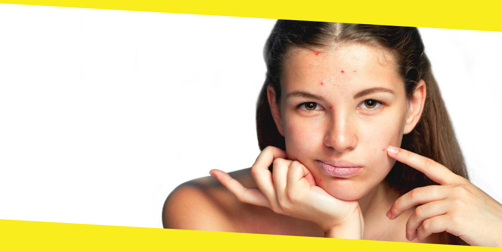 Facts About Acne