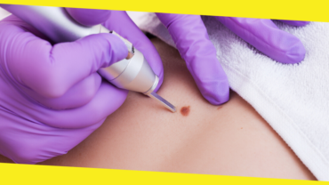 Your Cheat Sheet to Mole Removal in Singapore