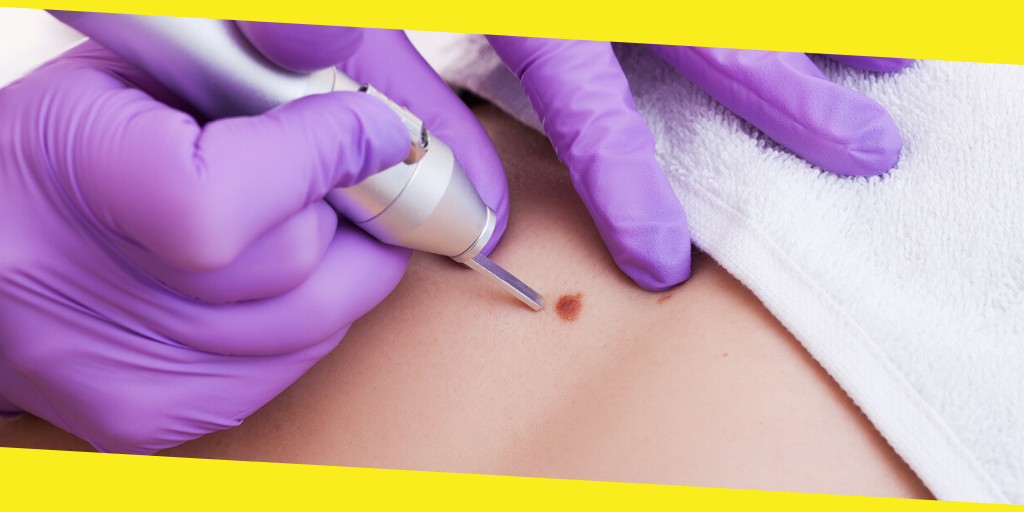 Mole Removal in Singapore