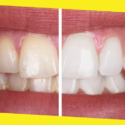 Pros and Cons of 6 Common Teeth Whitening Methods