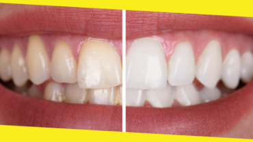 Pros and Cons of 6 Common Teeth Whitening Methods