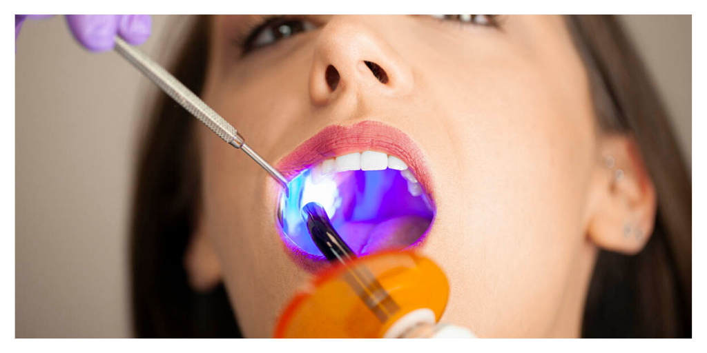 Pros and Cons of Common Teeth Whitening Methods