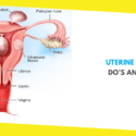 Uterine Fibroids: Do’s and Don’ts