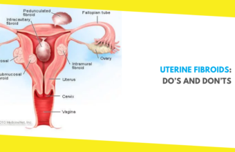 Uterine Fibroids: Do’s and Don’ts