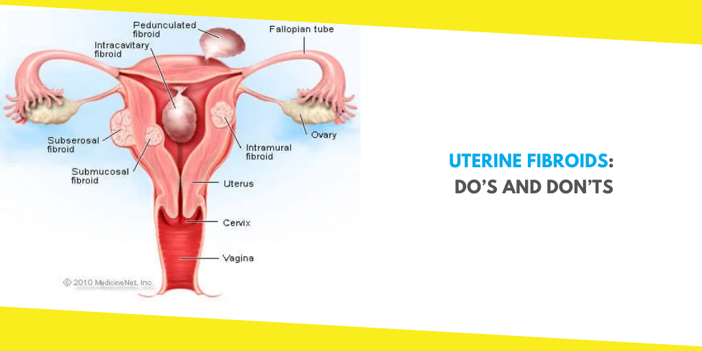 Uterine Fibroids Do's and Dont's