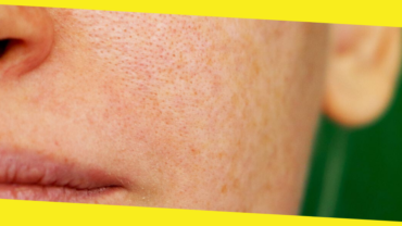 How to Find the Right Doctor to Remove Pigmentation from Face Permanently