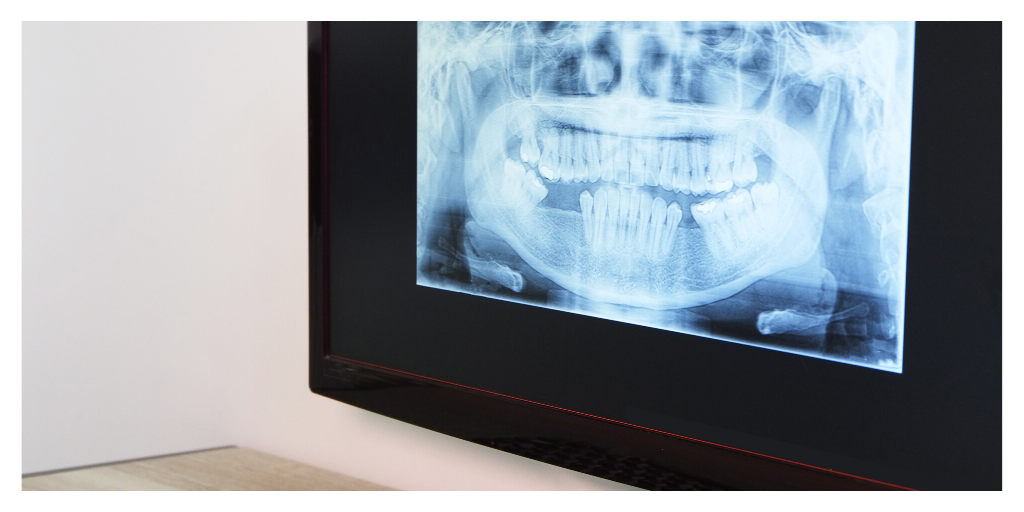 Getting a Digital X-Ray Before Doing Any Dental Procedure