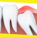 What Should You Do About a Wisdom Tooth Cavity? 