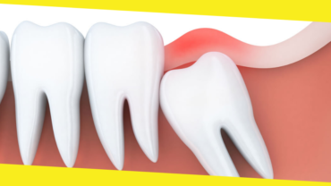 What Should You Do About a Wisdom Tooth Cavity? 