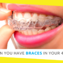 Can You Have Braces in Your 40s?