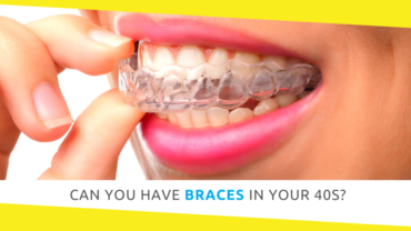 Can You Have Braces in Your 40s?