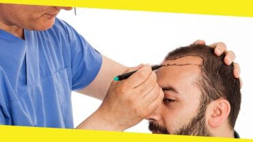 Turkey Hair Transplant – an Overview
