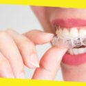 Invisalign The Coolest Dental Product