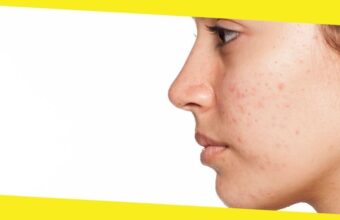 5 Unexpected Ways to Treat Your Acne