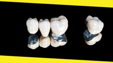 Lost a Dental Crown? Here’s What to Do