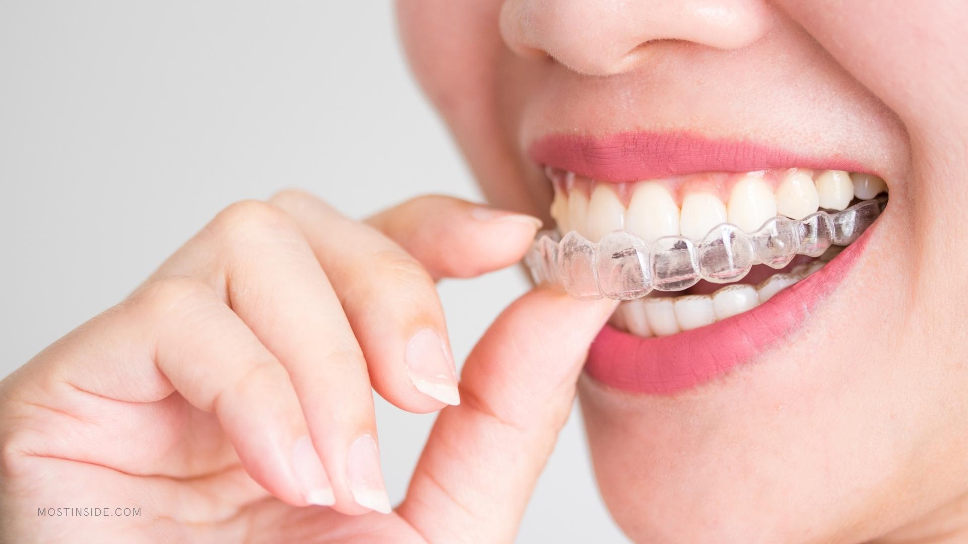 Getting Invisalign In Winnipeg